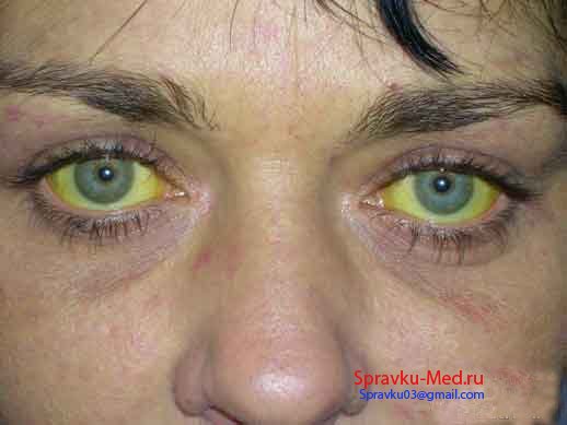 зараженнный гепатитом bc человек