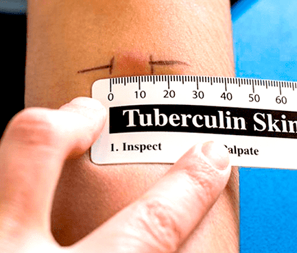 Купить справку о реакции манту